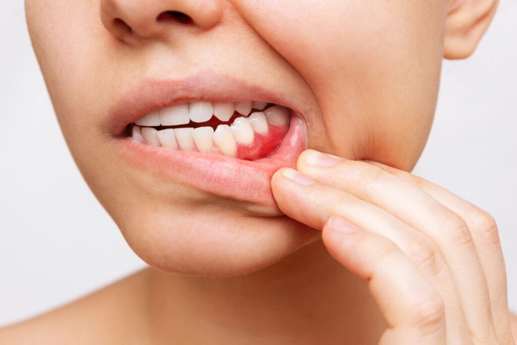 Close-up of a person's lower face showing a set of white teeth, with one hand pulling down the lower lip to reveal swollen and bleeding gums on one side, indicating dental inflammation or a toothache.