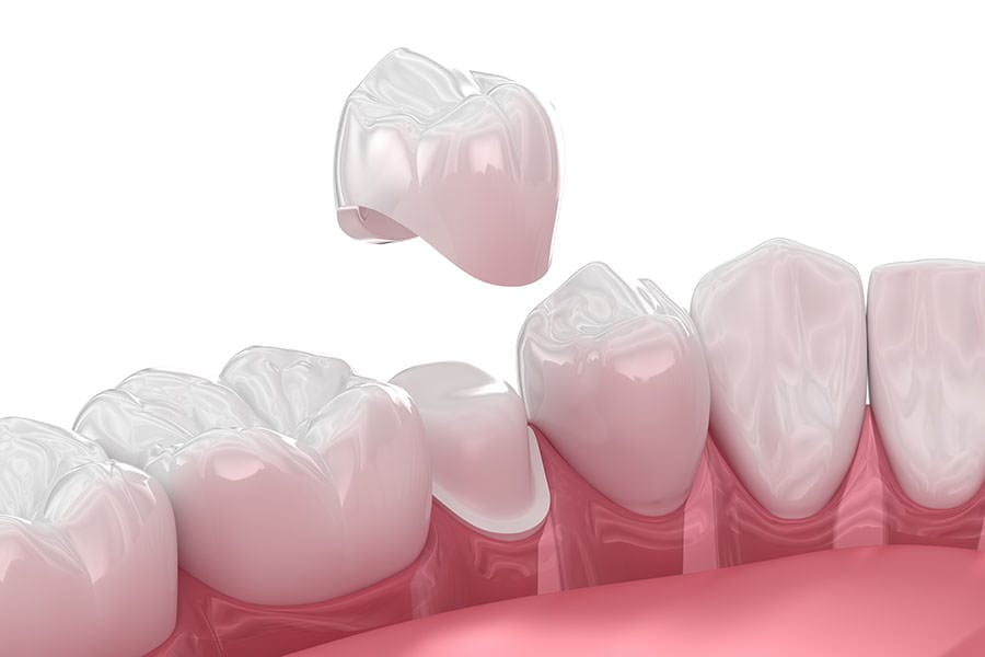 3D illustration of a dental crown being placed over a lower molar tooth, with a view of adjacent teeth in a row, set against a white background.