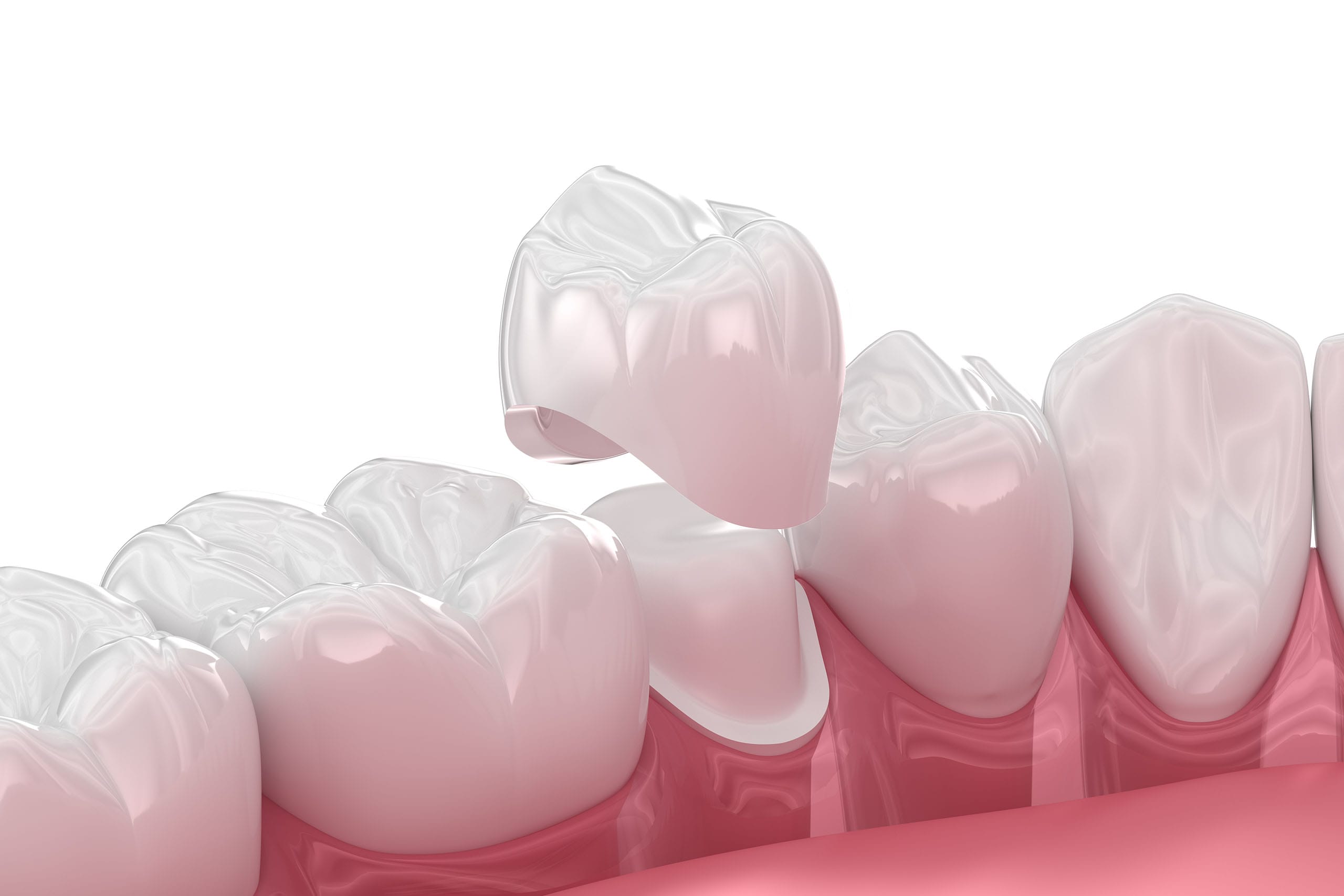 3D illustration of a dental crown being placed over a lower molar tooth, with a view of adjacent teeth in a row, set against a white background.