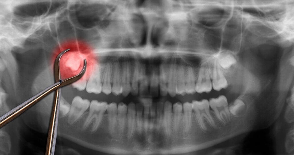 Panoramic dental X-ray showing an impacted wisdom tooth highlighted in red, with extraction forceps positioned near the tooth.