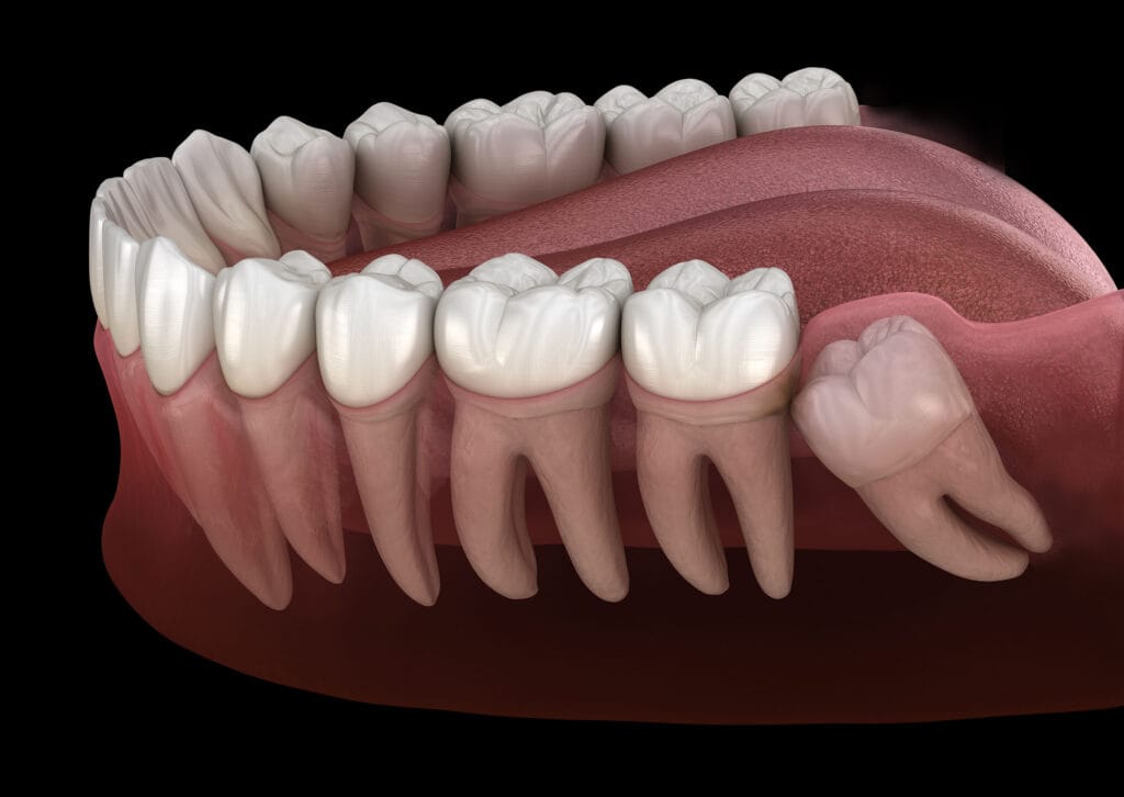 Impacted wisdom tooth growing sideways beneath gums and pressing against neighboring molar in lower jaw diagram